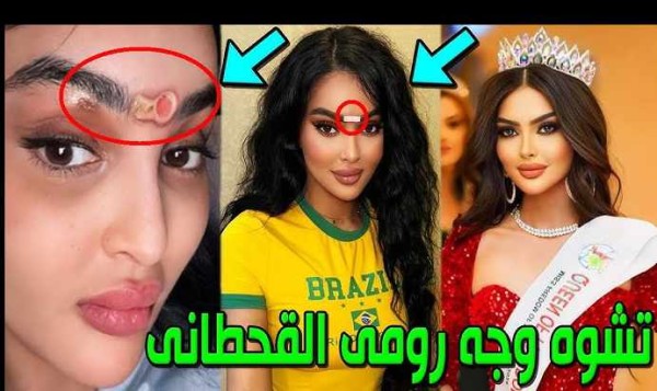 سبب تشوه وجه رومي القحطاني ويكيبيديا بالتفصيل